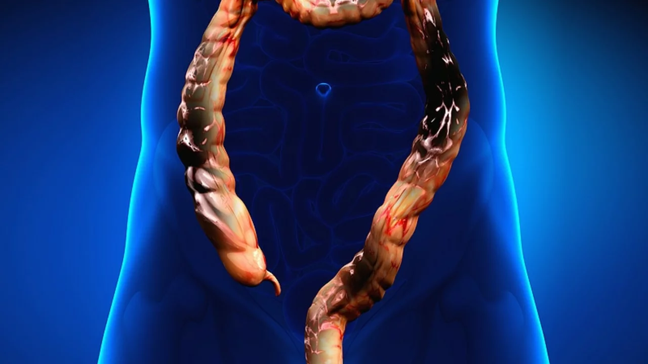 Il ruolo del sorafenib nel trattamento dei tumori stromali gastrointestinali